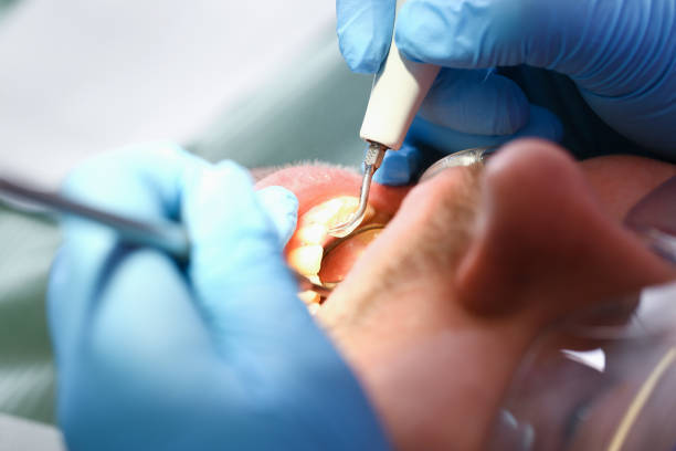 Best Broken or Chipped Tooth Repair in Villisca, IA